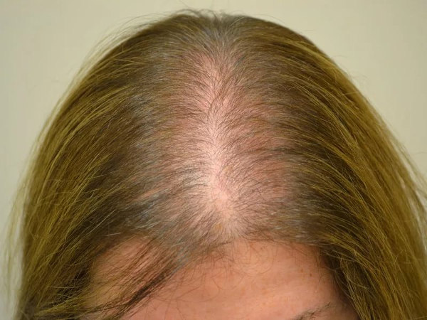 Признаки выпадения волос у женщин